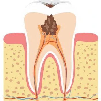 Etapy próchnicy zęba, zapalenie miazgi